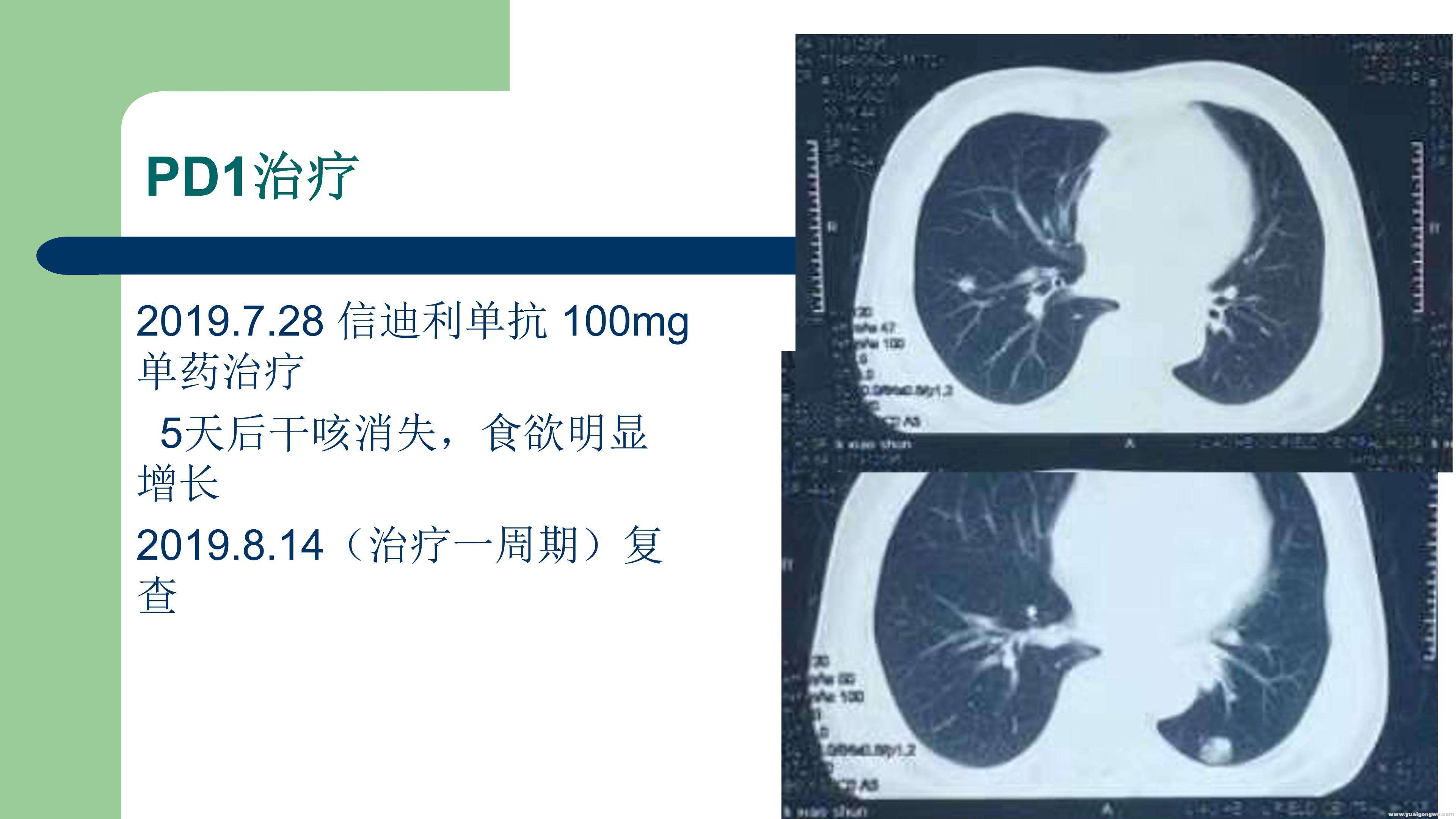 PD1病例分享_09.jpg