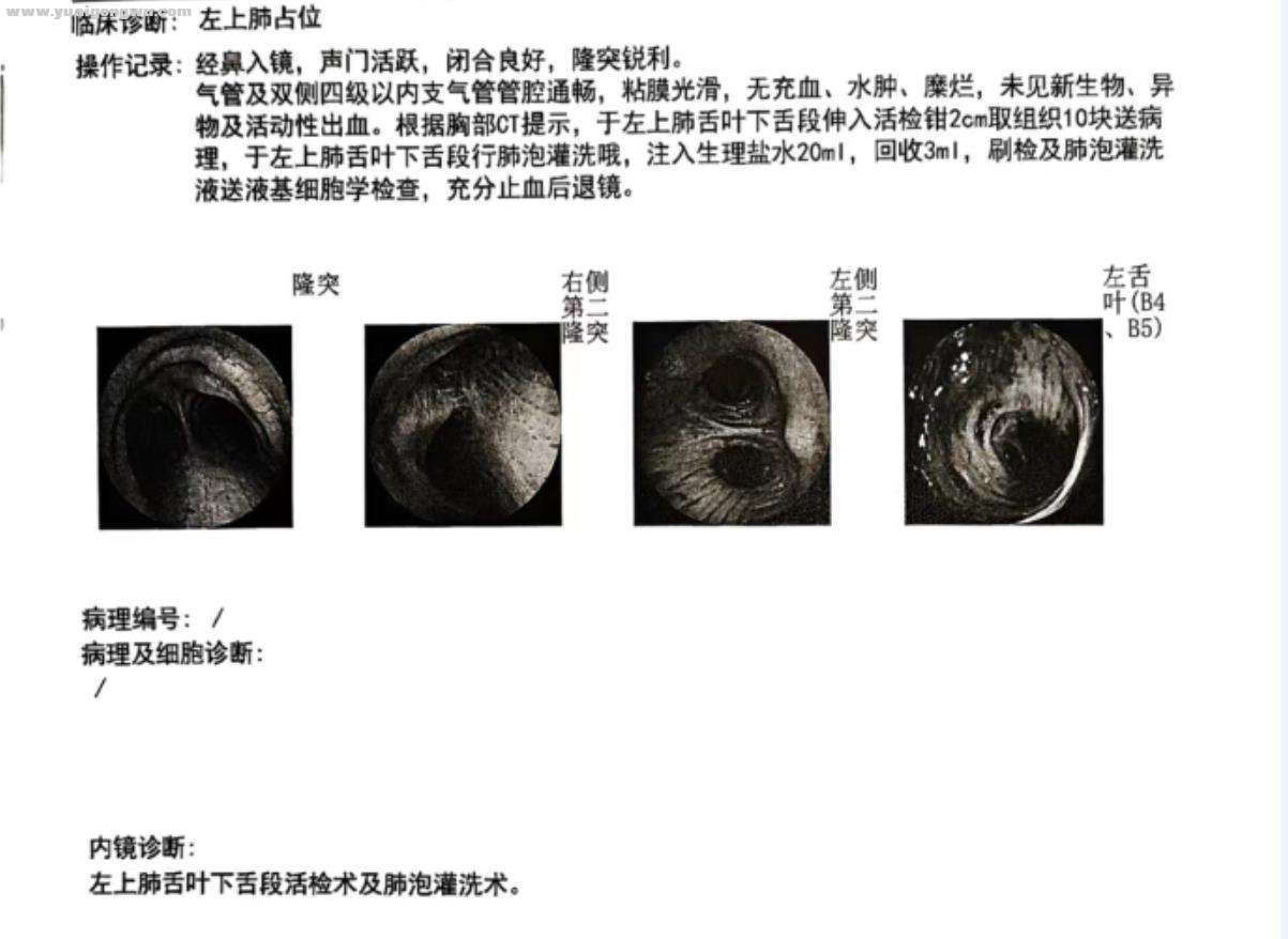 6月7日-电子气管镜检查报告单.jpg